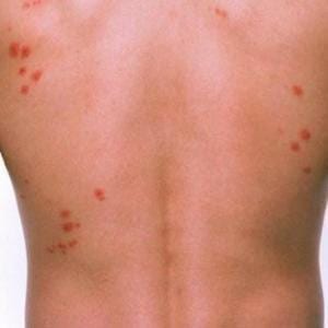 Cimici dei letti o bed bugs, come difendersi?